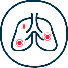 Lungenicon mit Entzündung durch Pneumokokken
